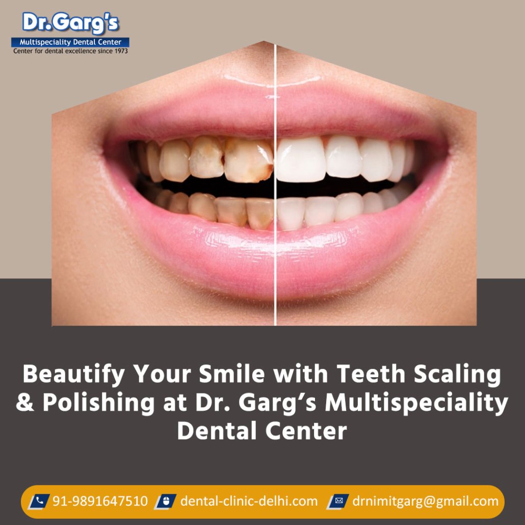 beautify your smile with teeth scaling and polishing at dr gargs multispeciality dental center 1030x1030 - Beautify Your Smile with Teeth Scaling and Polishing at Dr. Garg’s Multispeciality Dental Center